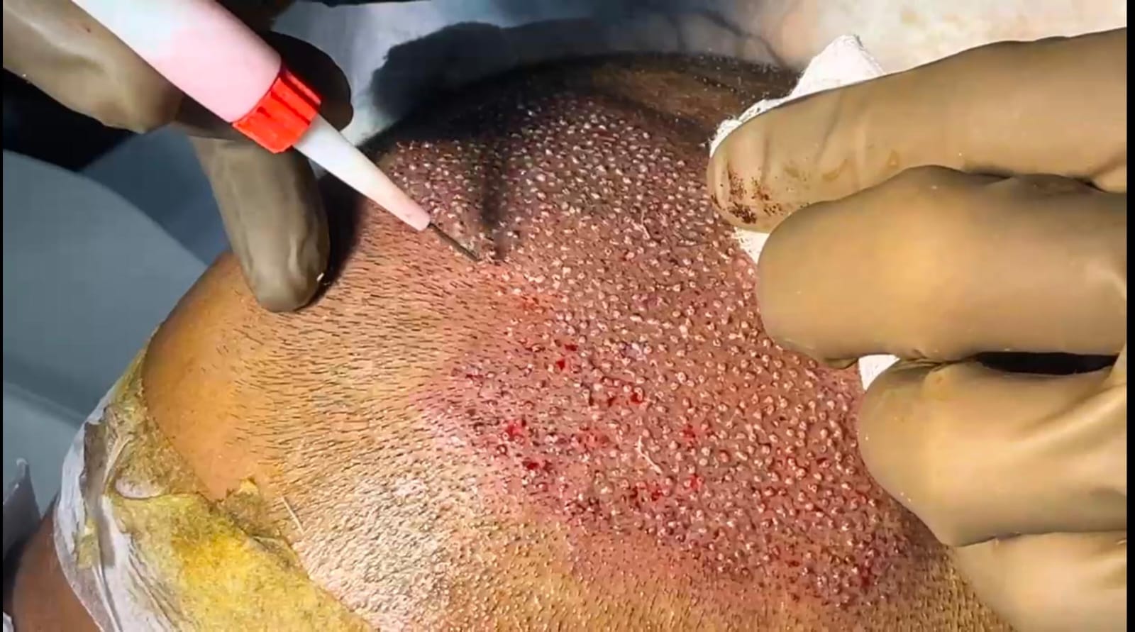 Hair Transplant