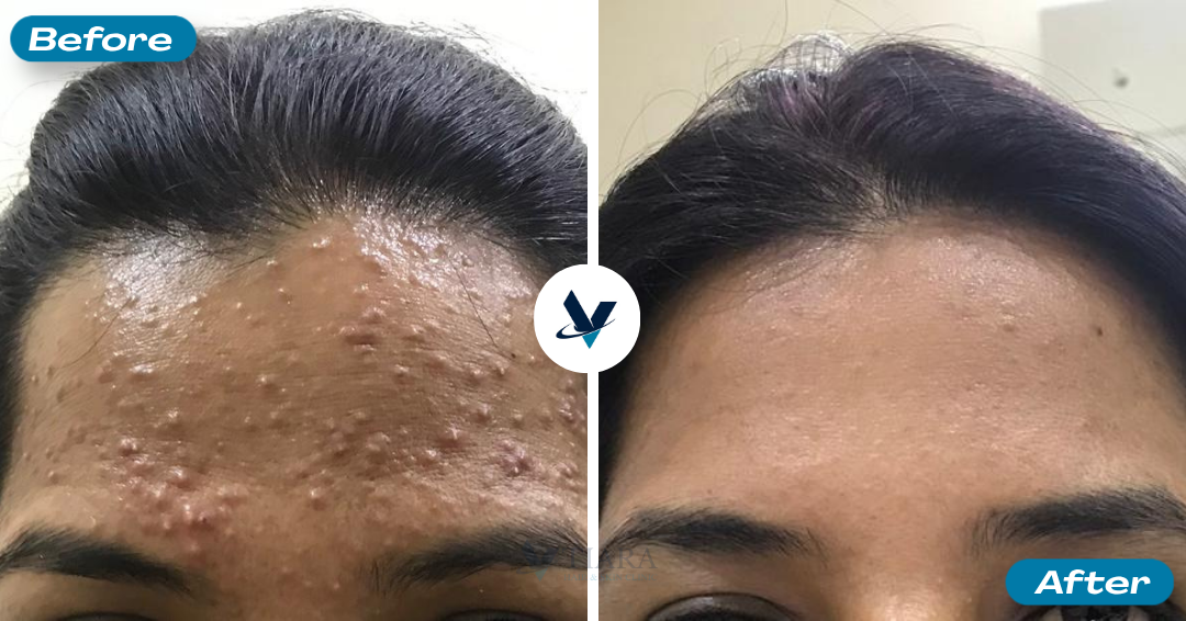 Acne Treatment Result 3 - Before and After