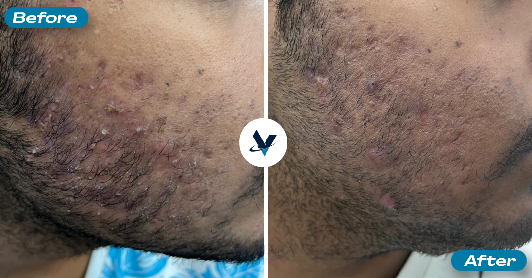 Acne Treatment Result 5 - Before and After