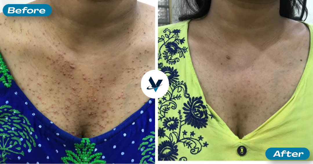 Acne Treatment Result 6 - Before and After