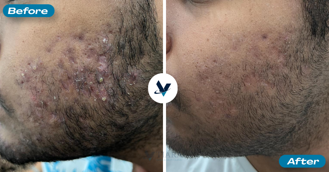 Acne Treatment Result 7 - Before and After