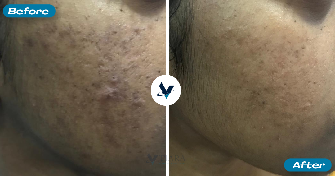 Acne Scar Treatment Result 1 - Before and After