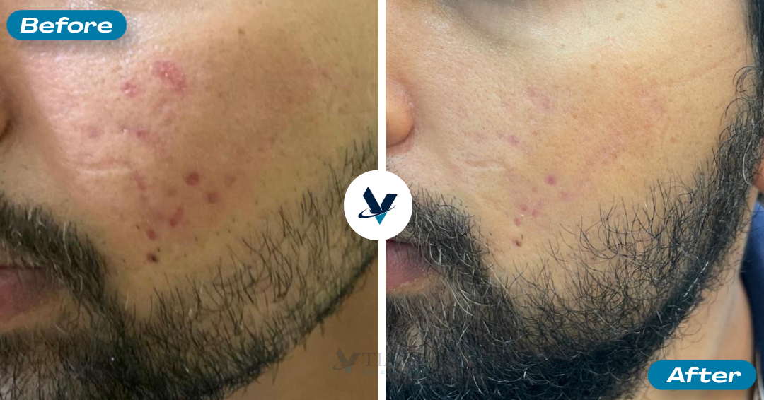 Acne Scar Treatment Result 2 - Before and After