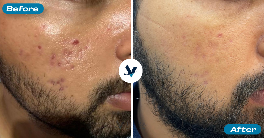 Acne Scar Treatment Result 3 - Before and After