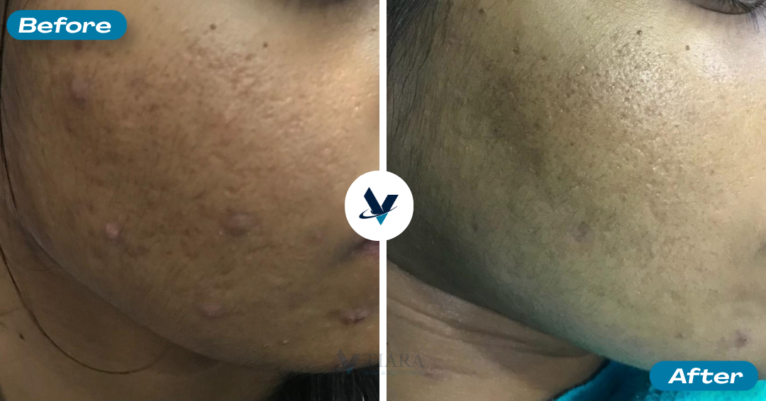 Acne Scar Treatment Result 4 - Before and After
