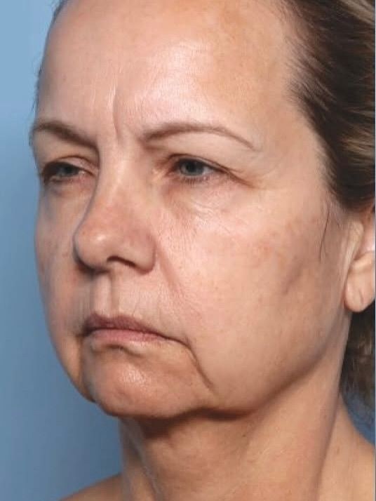 Top Anti-Aging Treatments