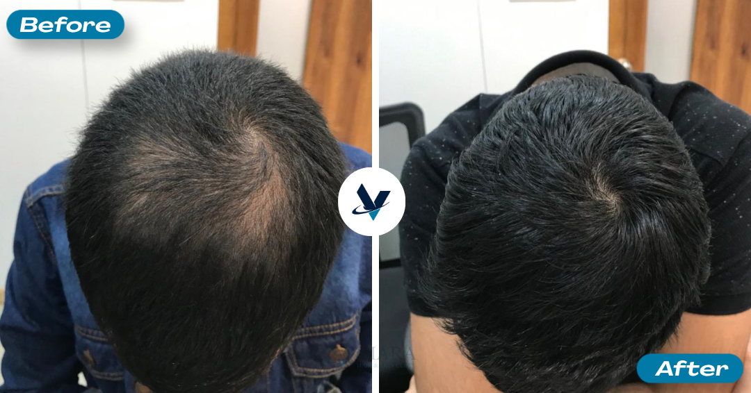 GFC Treatment Result 1 - Before and After