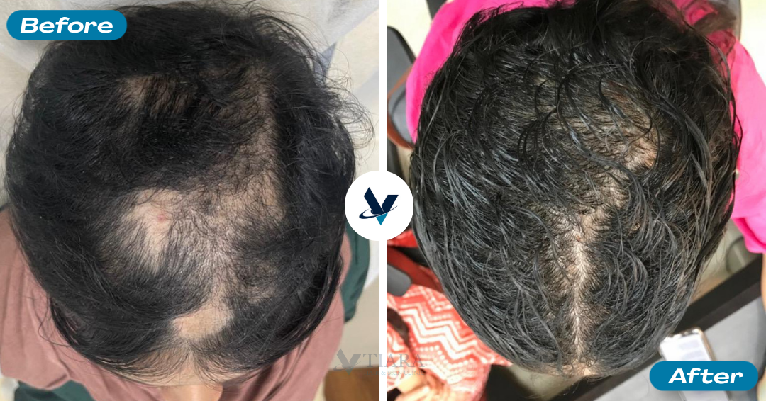 GFC Treatment Result 2 - Before and After