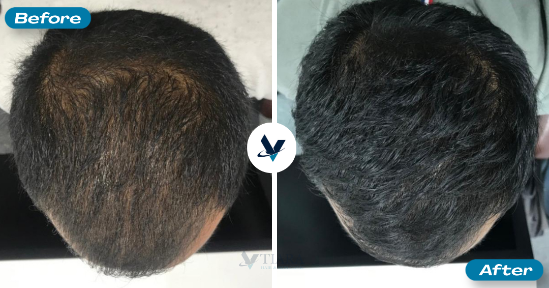 GFC Treatment Result 3 - Before and After