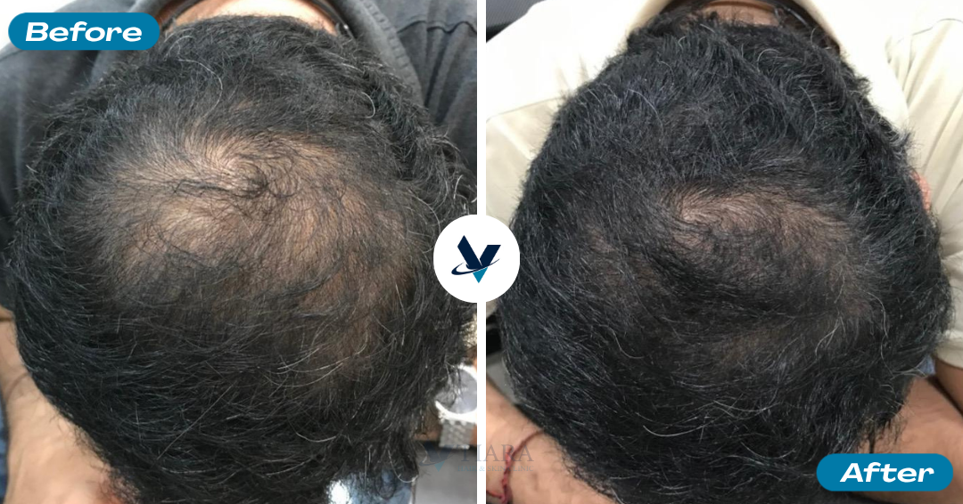 GFC Treatment Result 4 - Before and After