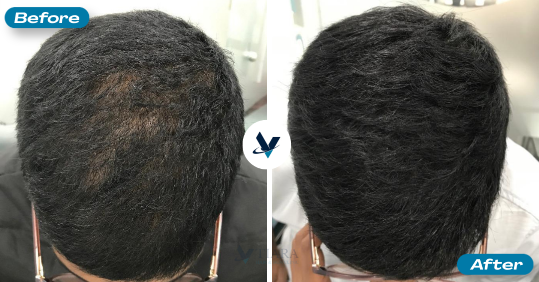GFC Treatment Result 5 - Before and After