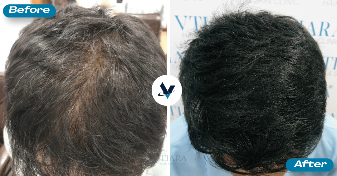 GFC Treatment Result 6 - Before and After