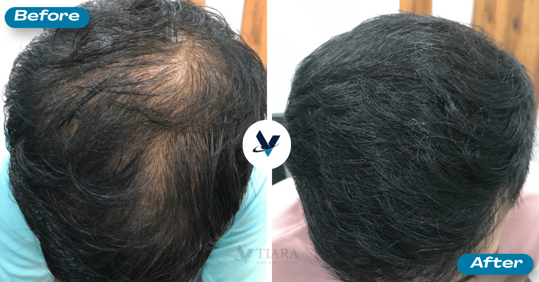 GFC Treatment Result 15 - Before and After