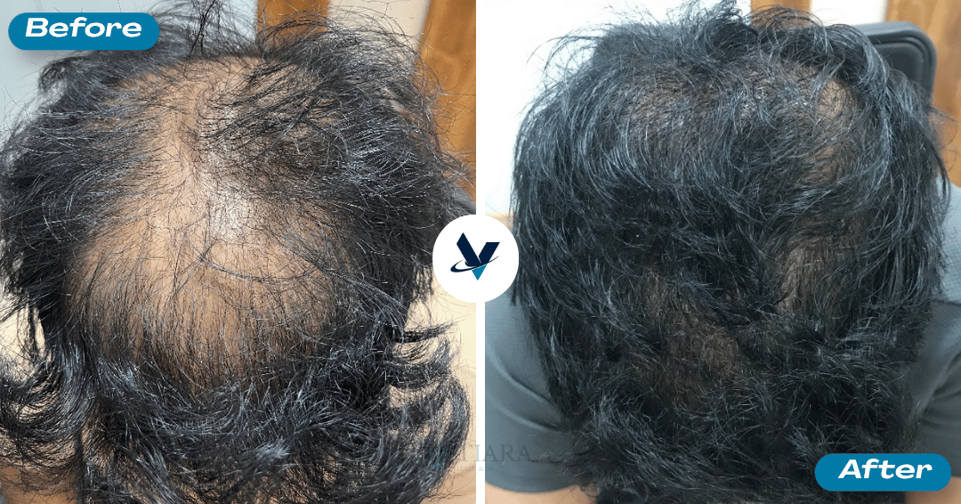 GFC Treatment Result 16 - Before and After