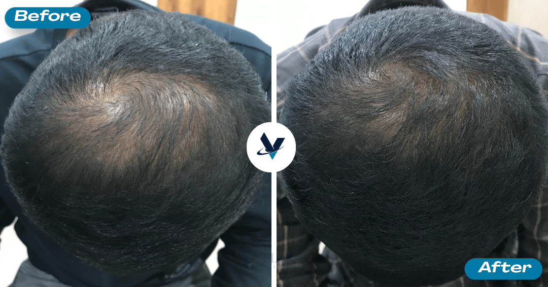 GFC Treatment Result 17 - Before and After