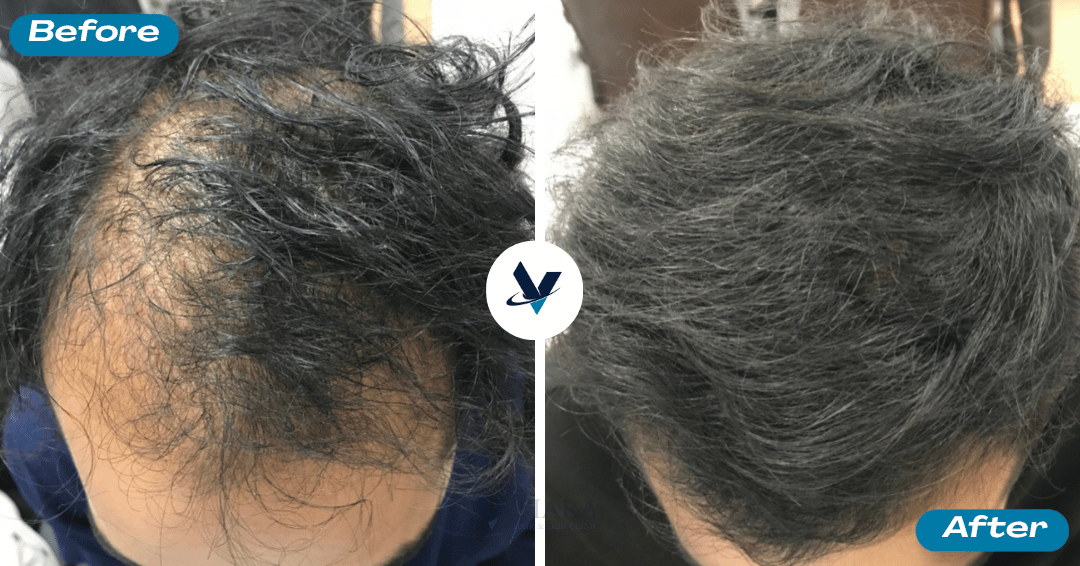 GFC Treatment Result 18 - Before and After