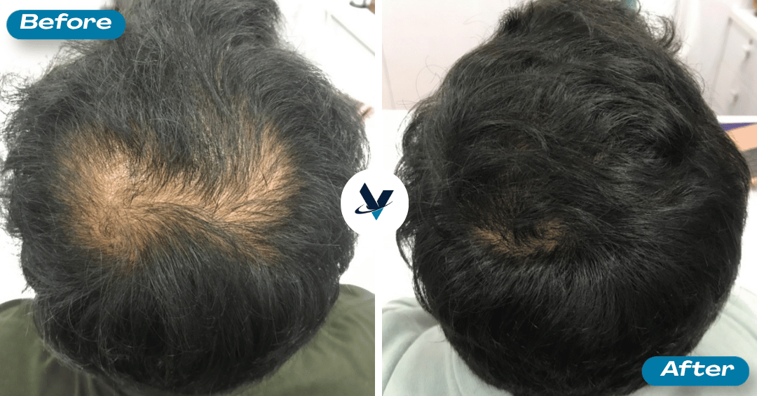 GFC Treatment Result 19 - Before and After