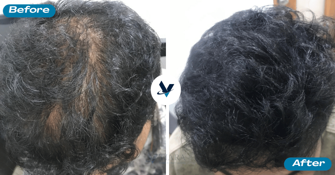 GFC Treatment Result 20 - Before and After