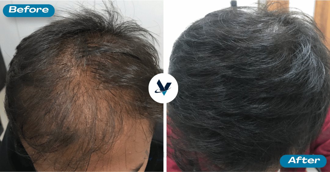 GFC Treatment Result 21 - Before and After