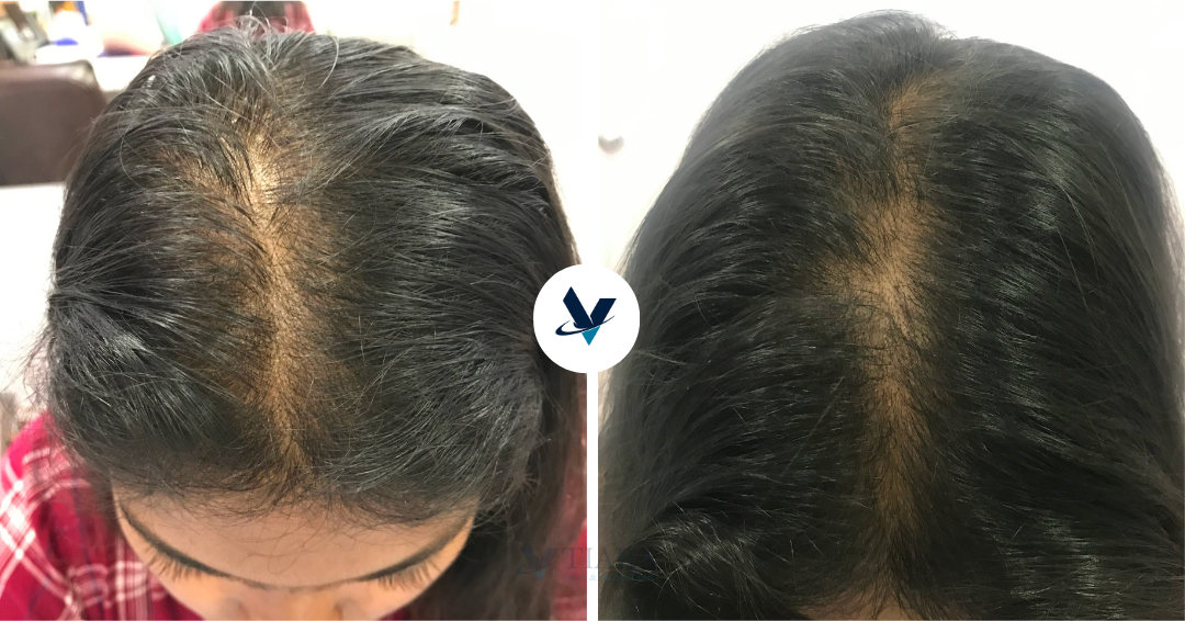 GFC Treatment Result 22 - Before and After