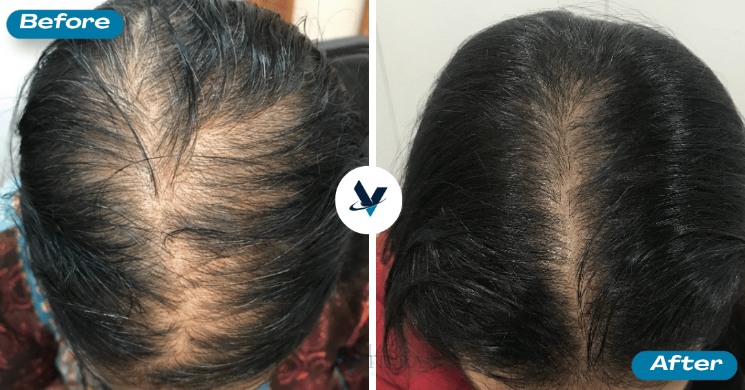 GFC Treatment Result 7 - Before and After