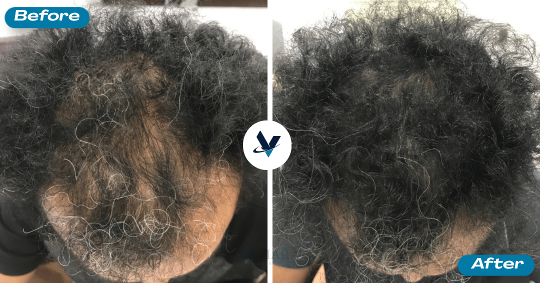 GFC Treatment Result 8 - Before and After
