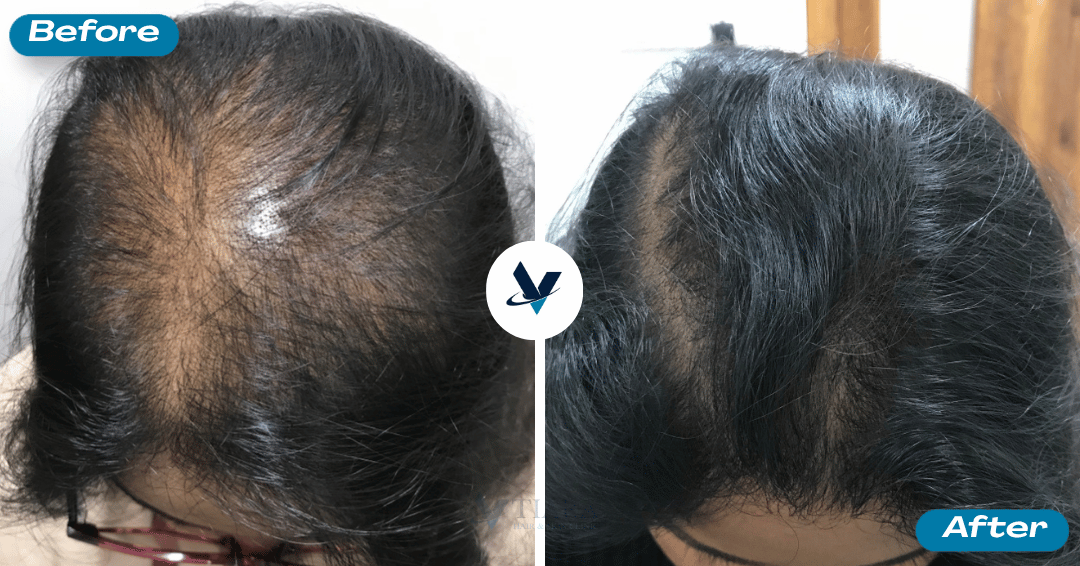 GFC Treatment Result 9 - Before and After