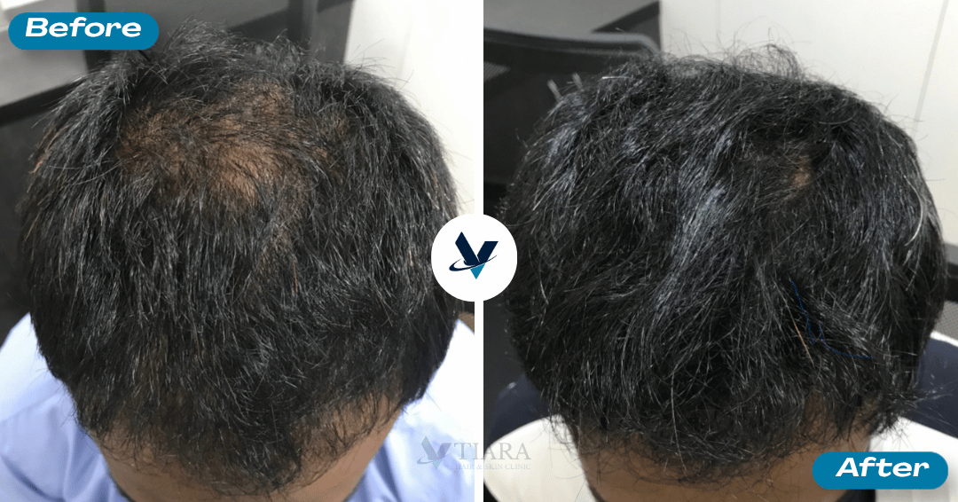 GFC Treatment Result 10 - Before and After
