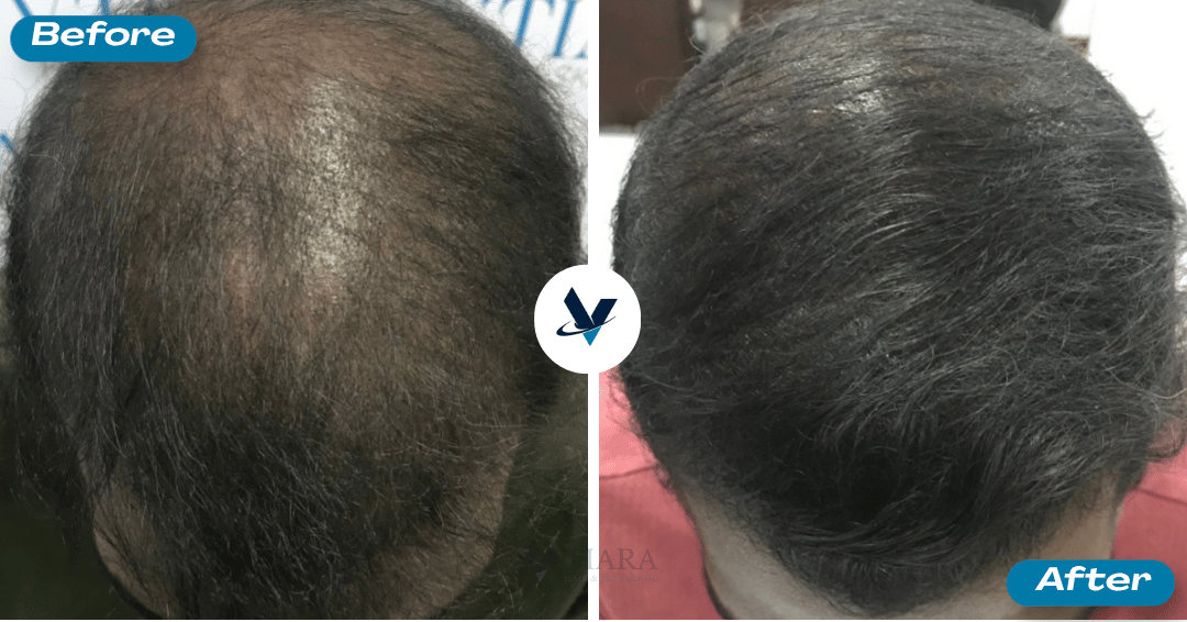 GFC Treatment Result 11 - Before and After
