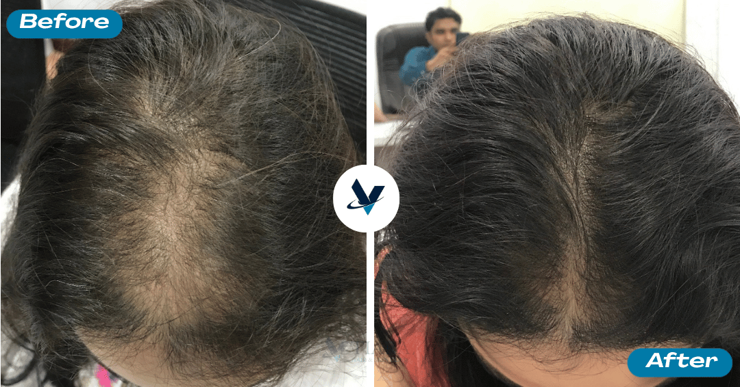 GFC Treatment Result 12 - Before and After