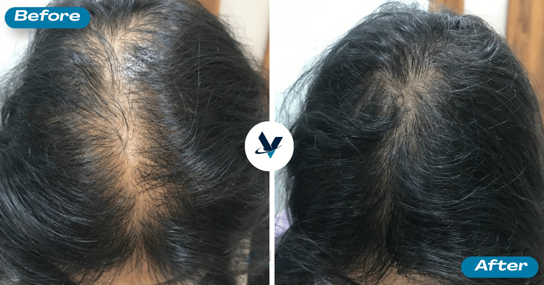 GFC Treatment Result 13 - Before and After