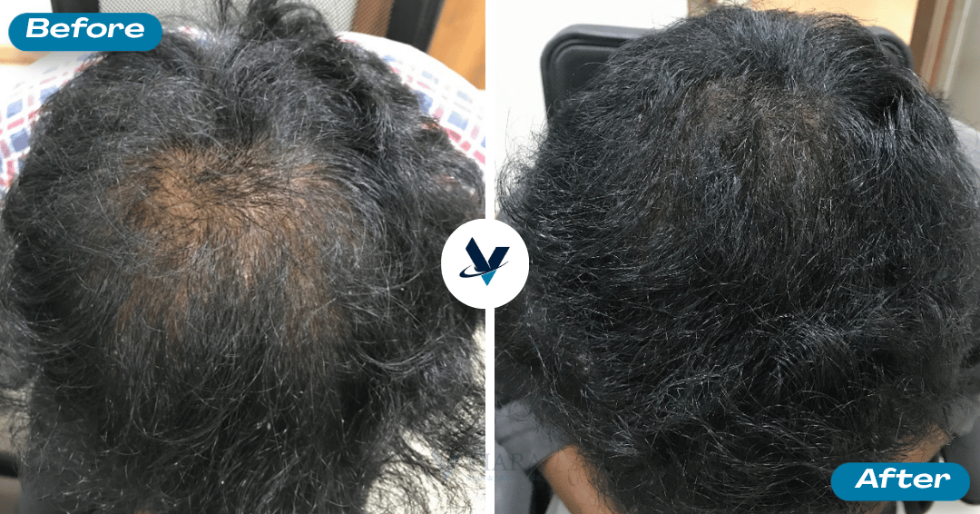 GFC Treatment Result 14 - Before and After