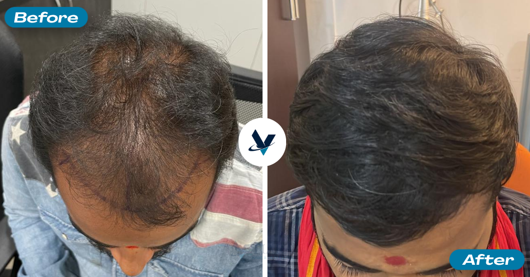 Hair Transplant Result 1 - Before and After