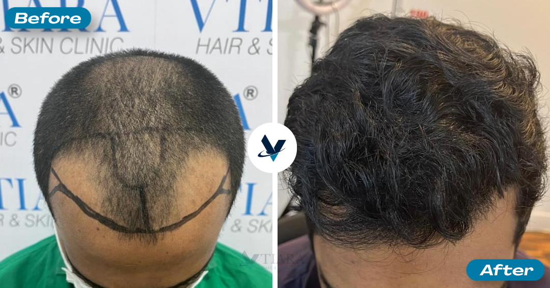 Hair Transplant Result 11 - Before and After