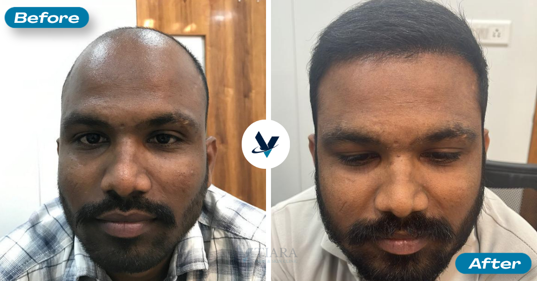 Hair Transplant Result 12 - Before and After