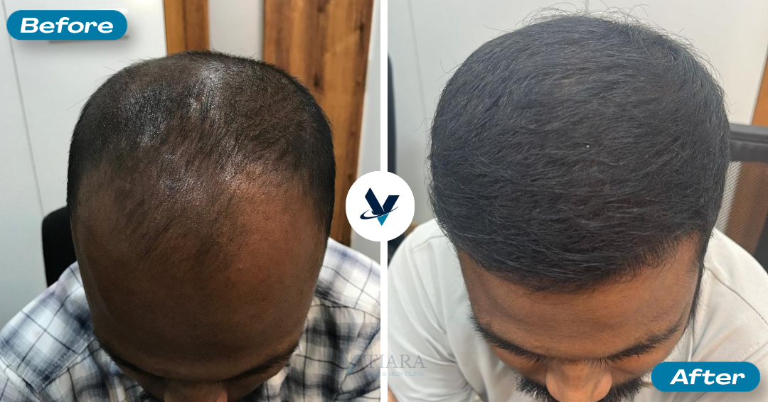 Hair Transplant Result 13 - Before and After
