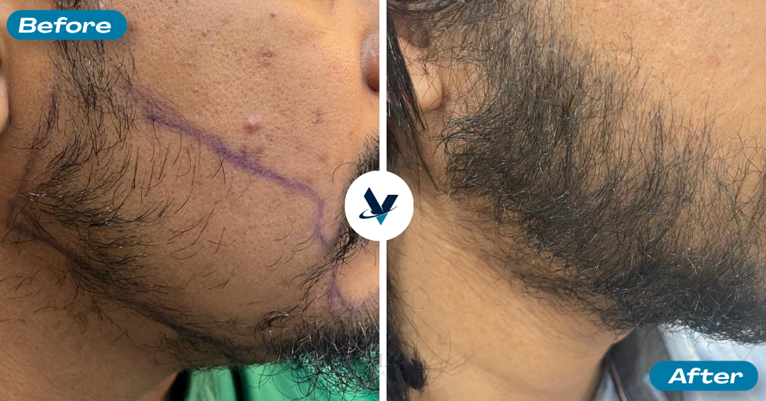 Beard Transplant Result 1 - Before and After