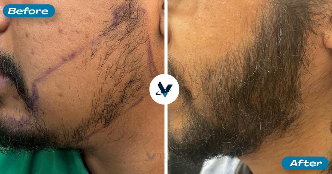 Beard Transplant Result 2 - Before and After