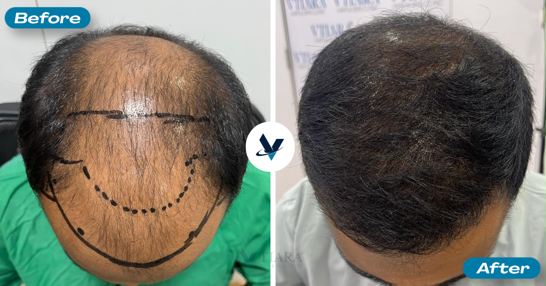 Beard Transplant Result 2 - Before and After