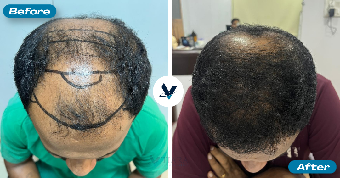 Hair Transplant Result 17 - Before and After