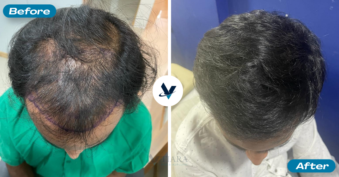 Hair Transplant Result 2 - Before and After