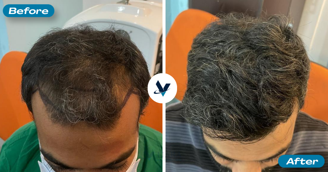 Hair Transplant Result 3 - Before and After