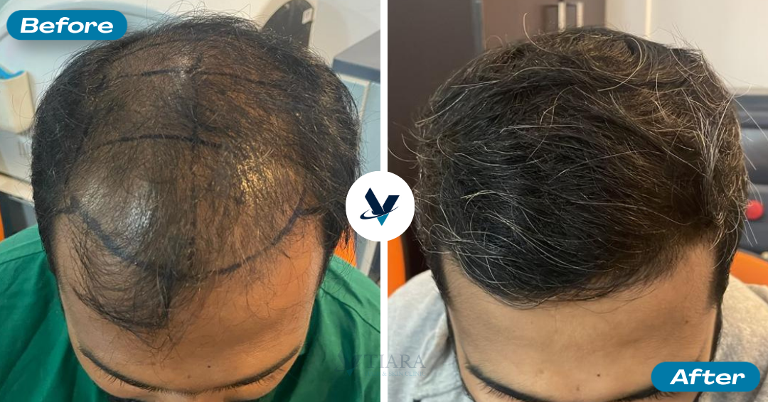 Hair Transplant Result 4 - Before and After
