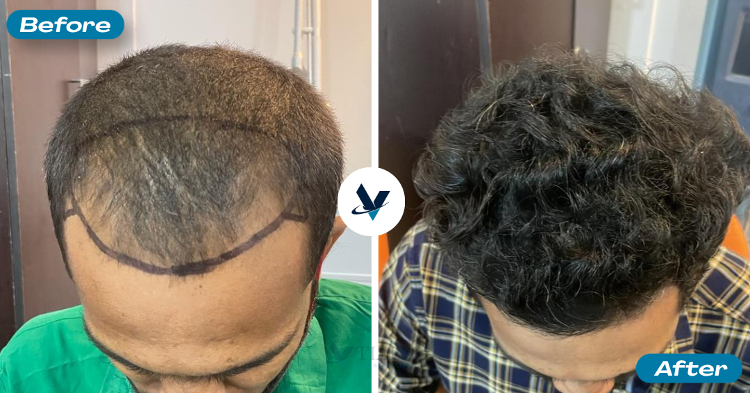 Hair Transplant Result 5 - Before and After