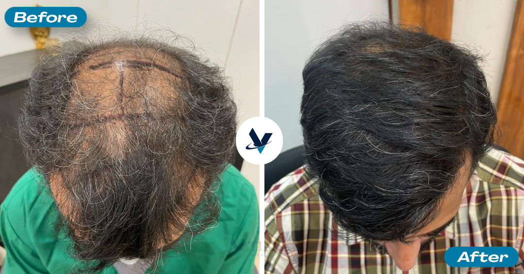 Hair Transplant Result 6 - Before and After