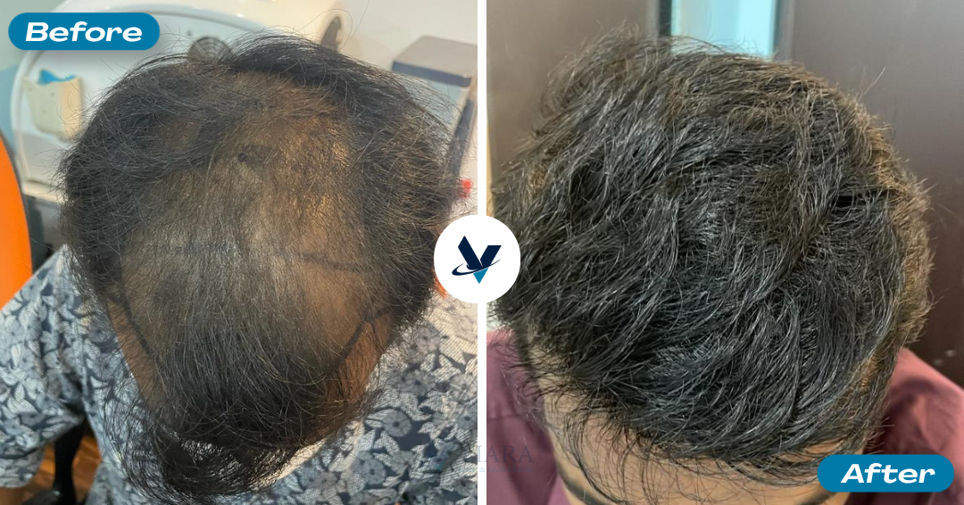 Hair Transplant Result 7 - Before and After