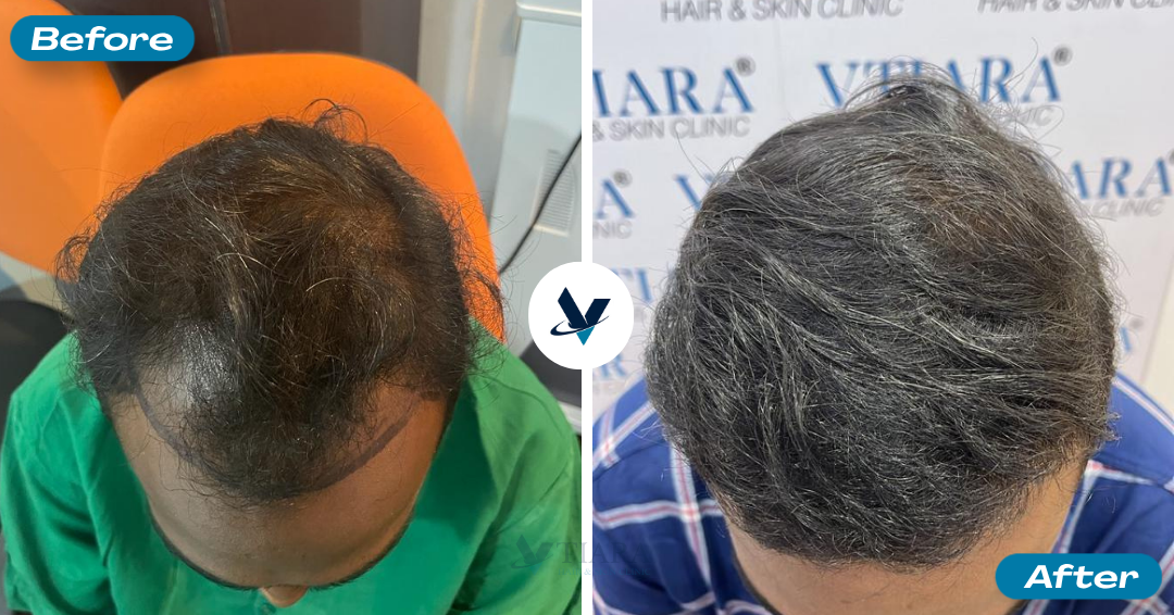 Hair Transplant Result 9 - Before and After