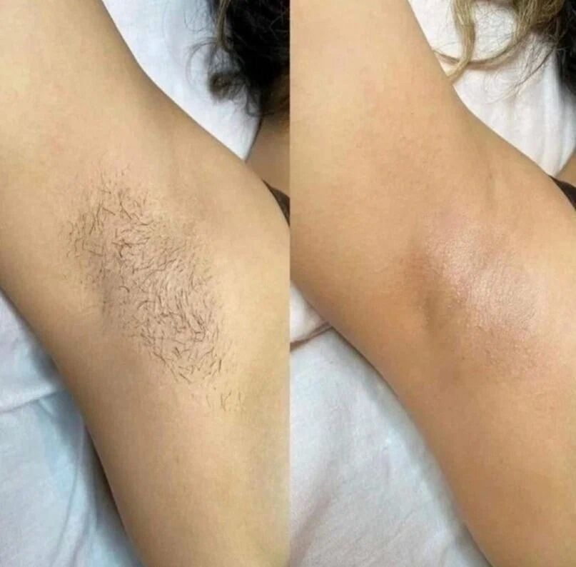 Laser Hair Removal Result 1 - Before and After