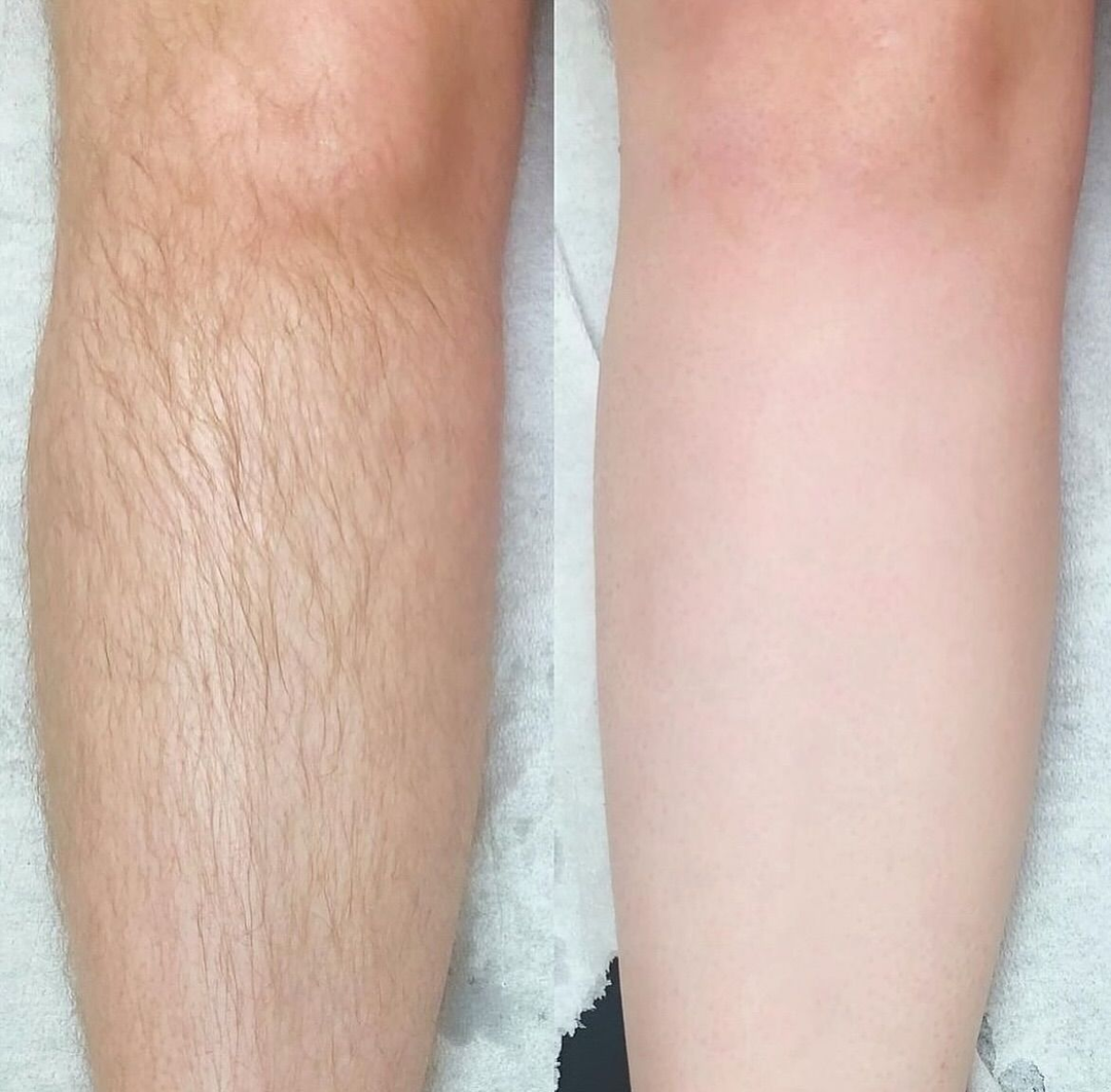 Laser Hair Removal Result 2 - Before and After
