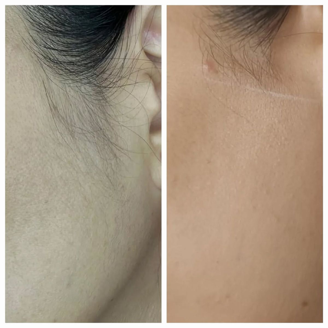 Laser Hair Removal Result 3 - Before and After